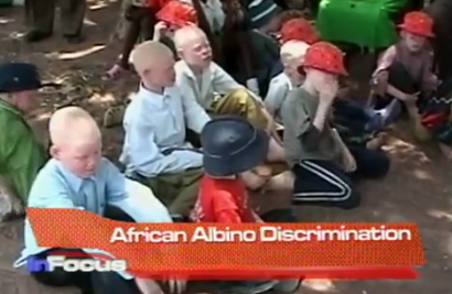 African Albino Descrimination